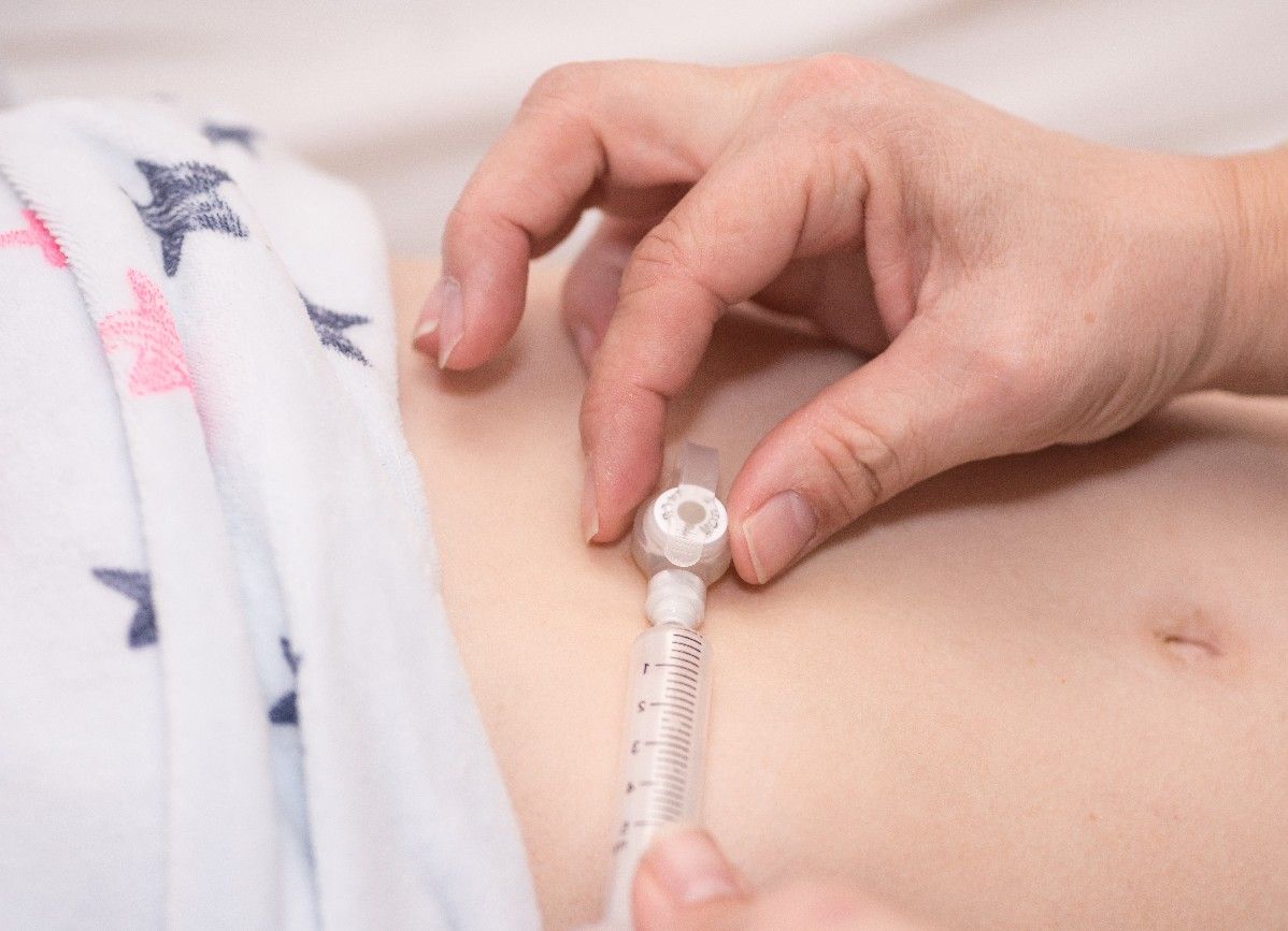 A medical feeding tube stock photo